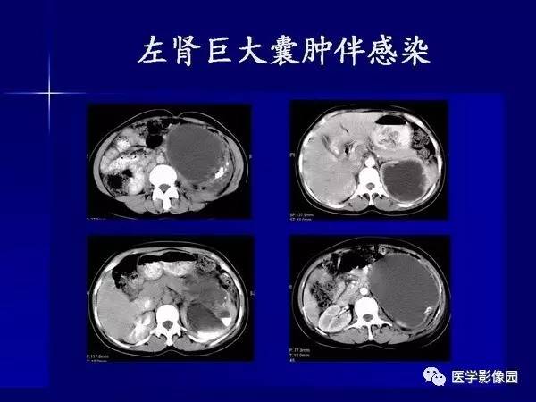【PPT】肾脏常见病变的CT诊断