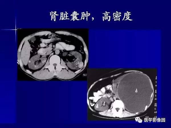 【PPT】肾脏常见病变的CT诊断
