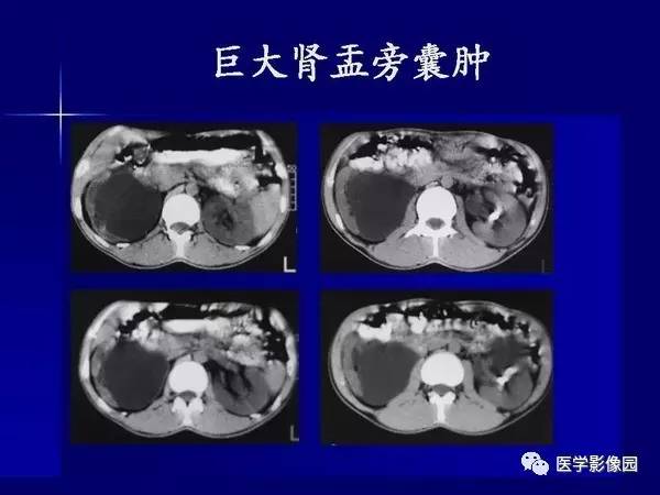 【PPT】肾脏常见病变的CT诊断
