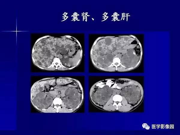 【PPT】肾脏常见病变的CT诊断