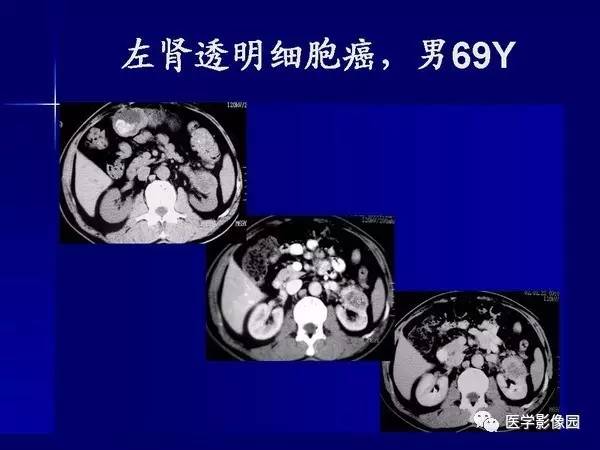 【PPT】肾脏常见病变的CT诊断