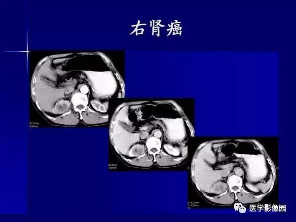 【PPT】肾脏常见病变的CT诊断