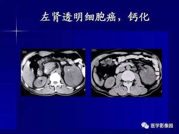 【PPT】肾脏常见病变的CT诊断
