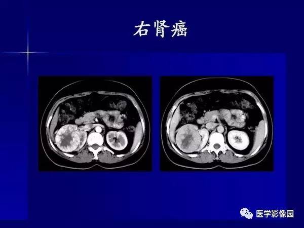 【PPT】肾脏常见病变的CT诊断
