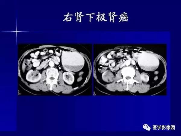 【PPT】肾脏常见病变的CT诊断