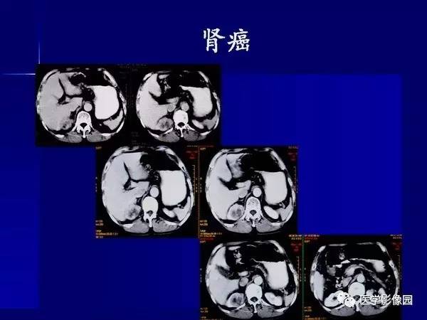 【PPT】肾脏常见病变的CT诊断