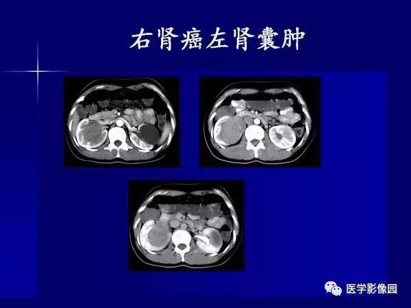 【PPT】肾脏常见病变的CT诊断
