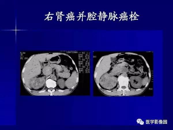 【PPT】肾脏常见病变的CT诊断