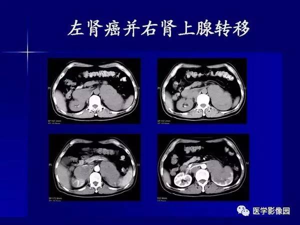 【PPT】肾脏常见病变的CT诊断