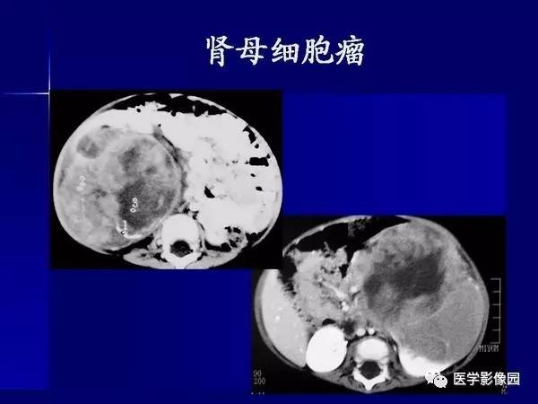 【PPT】肾脏常见病变的CT诊断