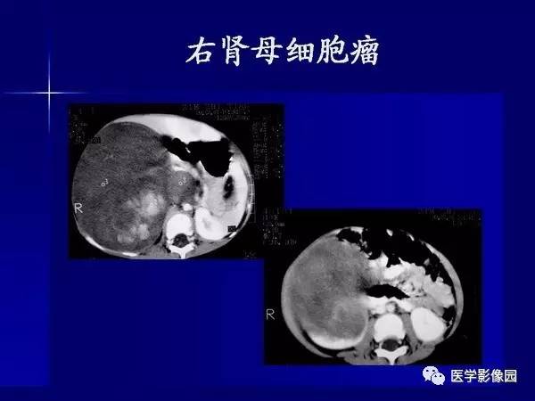 【PPT】肾脏常见病变的CT诊断