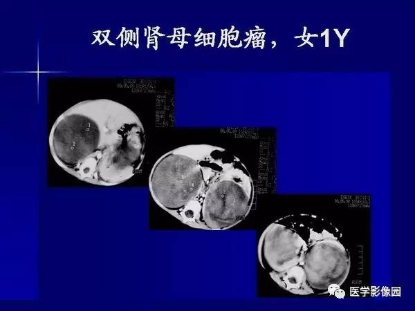 【PPT】肾脏常见病变的CT诊断