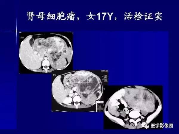 【PPT】肾脏常见病变的CT诊断