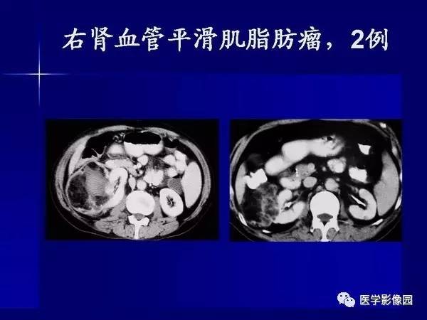 【PPT】肾脏常见病变的CT诊断
