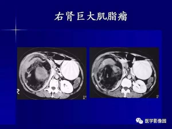 【PPT】肾脏常见病变的CT诊断