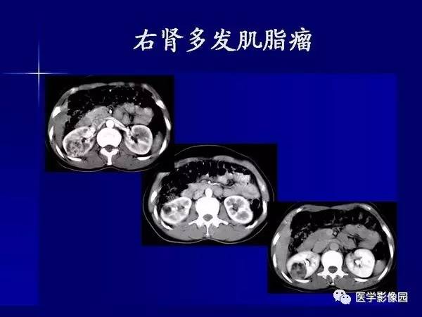 【PPT】肾脏常见病变的CT诊断
