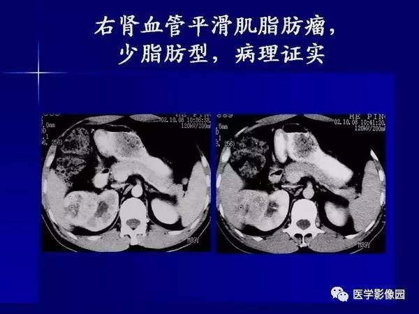 【PPT】肾脏常见病变的CT诊断