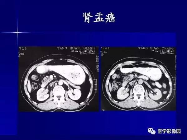 【PPT】肾脏常见病变的CT诊断