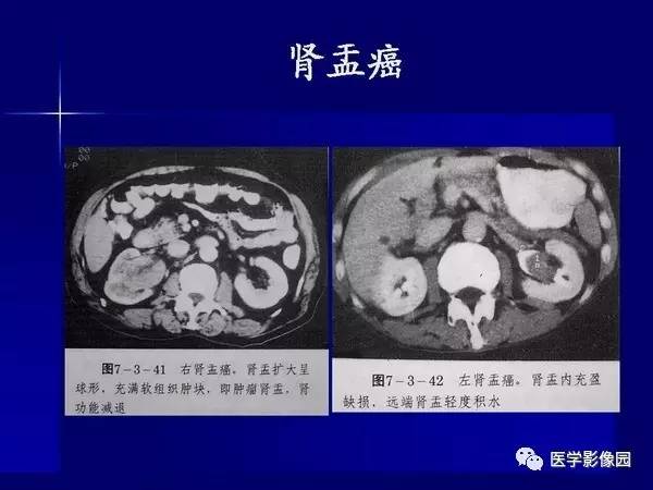 【PPT】肾脏常见病变的CT诊断
