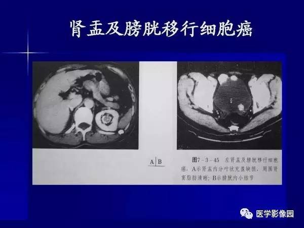【PPT】肾脏常见病变的CT诊断