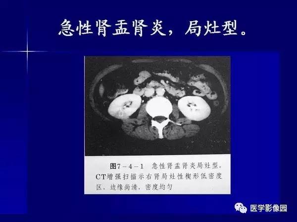 【PPT】肾脏常见病变的CT诊断