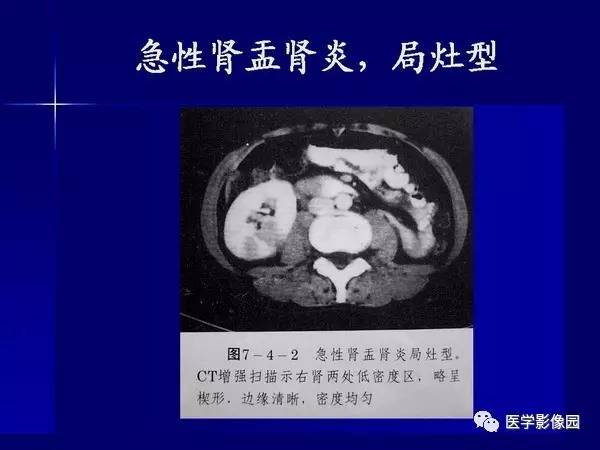 【PPT】肾脏常见病变的CT诊断