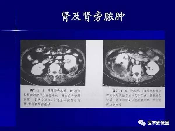 【PPT】肾脏常见病变的CT诊断