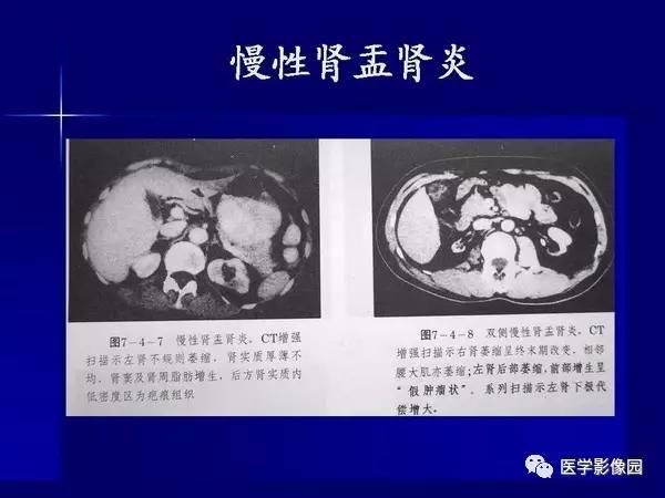 【PPT】肾脏常见病变的CT诊断