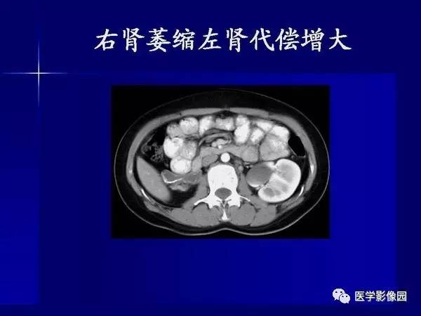【PPT】肾脏常见病变的CT诊断