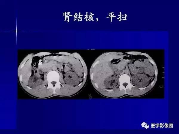 【PPT】肾脏常见病变的CT诊断