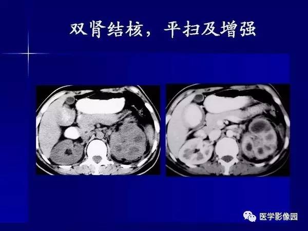 【PPT】肾脏常见病变的CT诊断