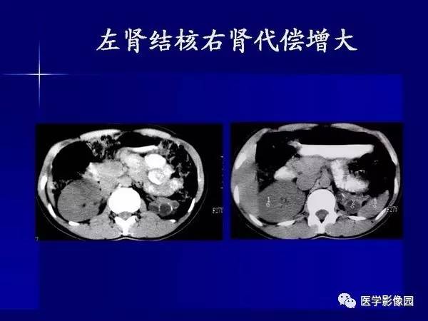 【PPT】肾脏常见病变的CT诊断