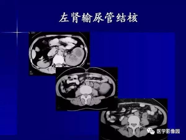 【PPT】肾脏常见病变的CT诊断