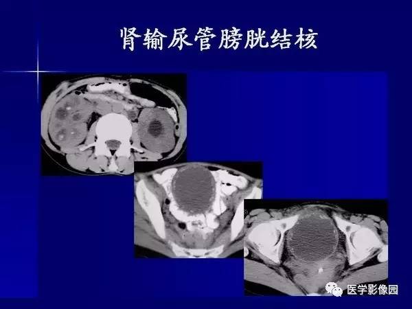【PPT】肾脏常见病变的CT诊断