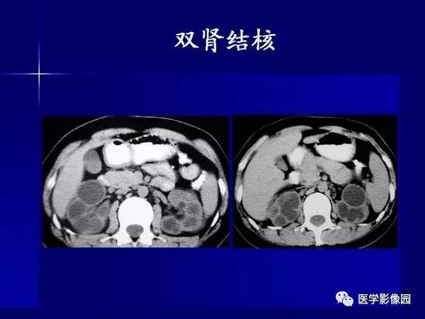 【PPT】肾脏常见病变的CT诊断