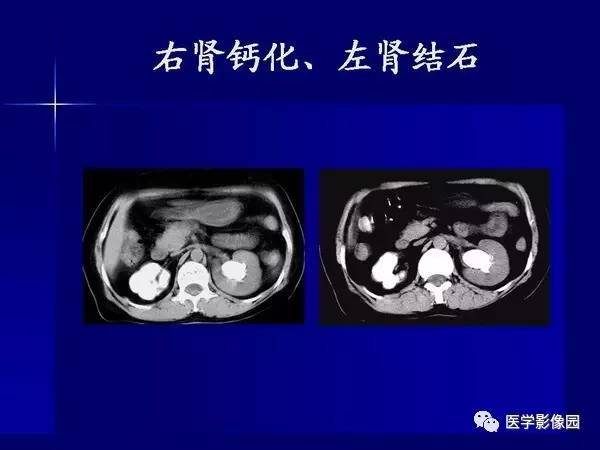 【PPT】肾脏常见病变的CT诊断