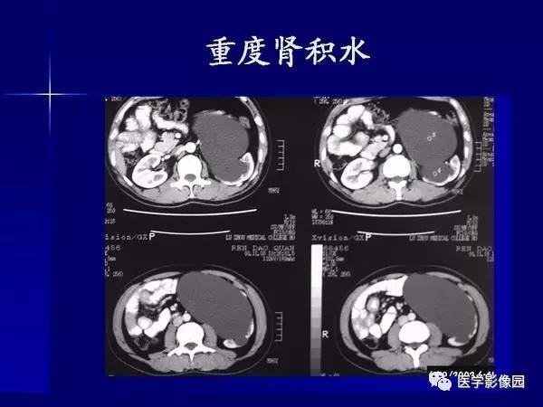 【PPT】肾脏常见病变的CT诊断