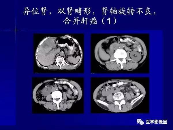 【PPT】肾脏常见病变的CT诊断