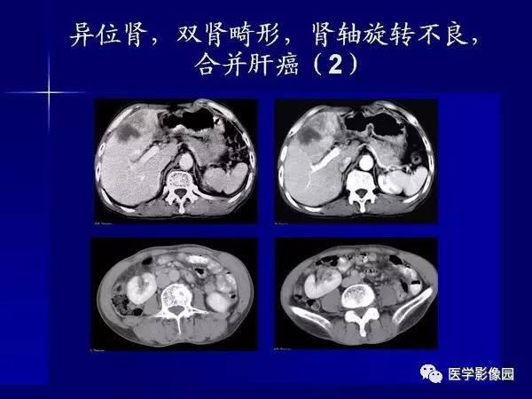 【PPT】肾脏常见病变的CT诊断