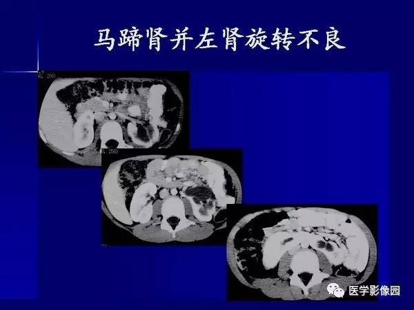 【PPT】肾脏常见病变的CT诊断