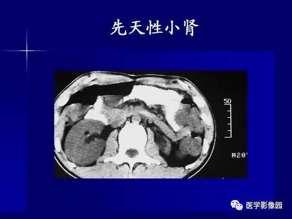 【PPT】肾脏常见病变的CT诊断