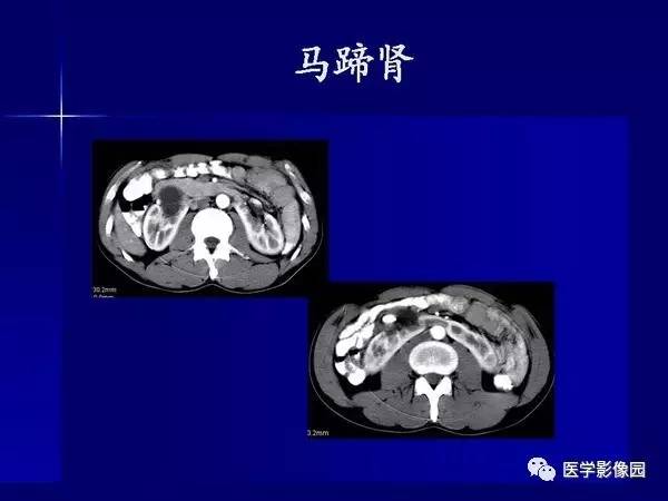 【PPT】肾脏常见病变的CT诊断