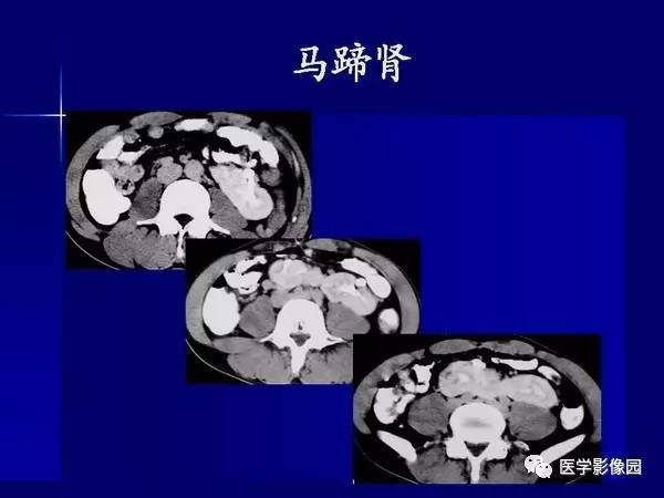 【PPT】肾脏常见病变的CT诊断