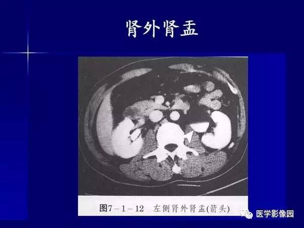 【PPT】肾脏常见病变的CT诊断
