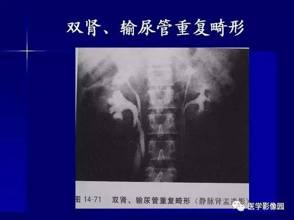 【PPT】肾脏常见病变的CT诊断