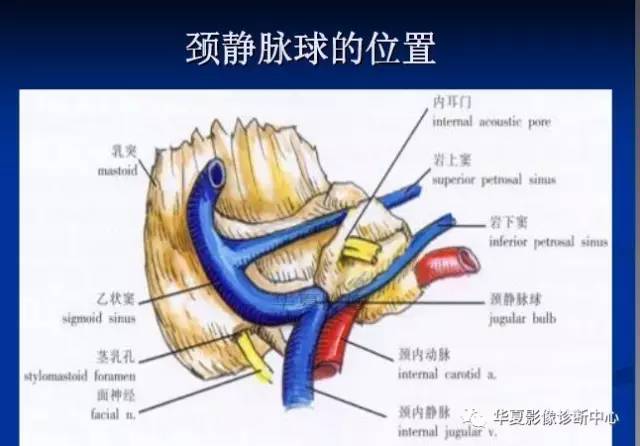 颈静脉球的变异与疾病诊断