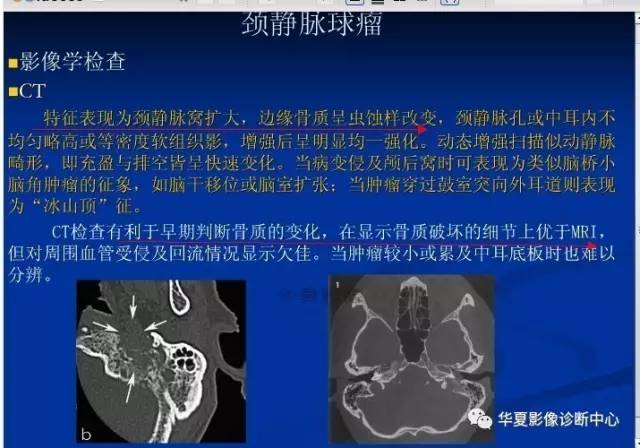 颈静脉球的变异与疾病诊断