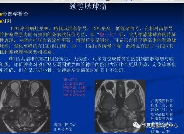 颈静脉球的变异与疾病诊断