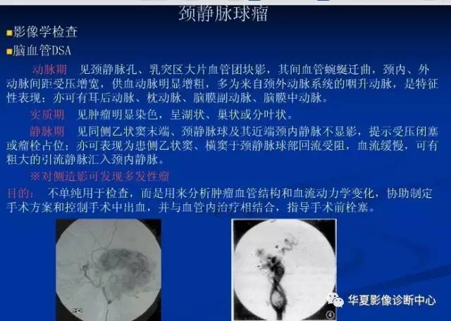 颈静脉球的变异与疾病诊断