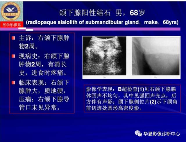 【PPT】涎腺疾病与颞下颌关节疾病影像诊断